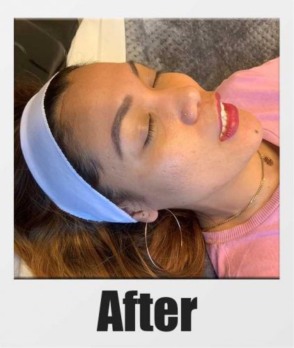 An After photo of Microneedling with PRP in Seattle, Bellevue, and Kirkland