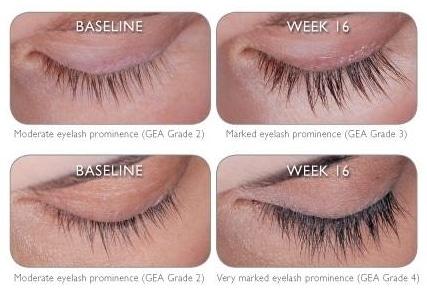 a before and after set of photos showing the effects of latisse