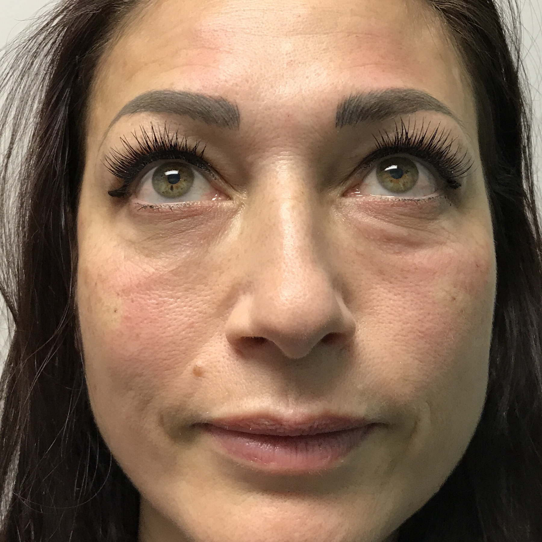 An After photo of PRP For Tear Troughs by Injector Lynda in Seattle, Bellevue, and Kirkland