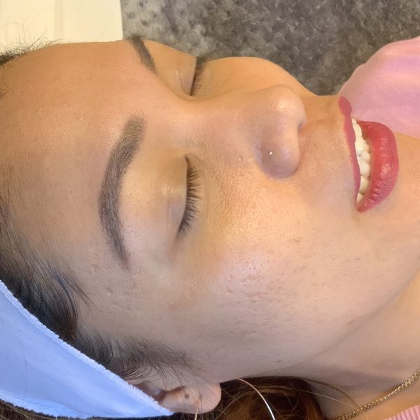 An After photo of Microneedling With PRP by Master Esthetician Kyla in Seattle, Bellevue, and Kirkland
