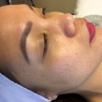 A Before photo of Microneedling With PRP by Master Esthetician Kyla in Seattle, Bellevue, and Kirkland