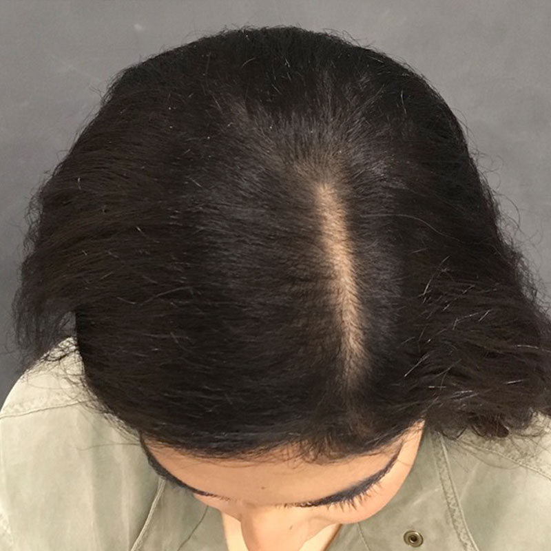 An After photo of PRP With ACell Hair Restoration by Dr. Javad Sajan in Seattle, Bellevue, and Kirkland