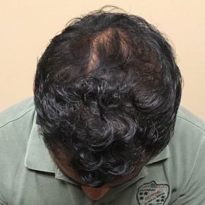 PRP Hair Restoration After Hair Transplant Seattle, Bellevue, Kirkland PRP Hair Restoration After Hair Transplant Seattle, Bellevue, Kirkland