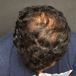 PRP Hair Restoration After Hair Transplant Seattle, Bellevue, Kirkland PRP Hair Restoration After Hair Transplant Seattle, Bellevue, Kirkland
