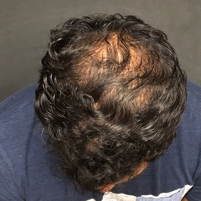 A Before photo of PRP With ACell Hair Restoration by Dr. Javad Sajan in Seattle, Bellevue, and Kirkland
