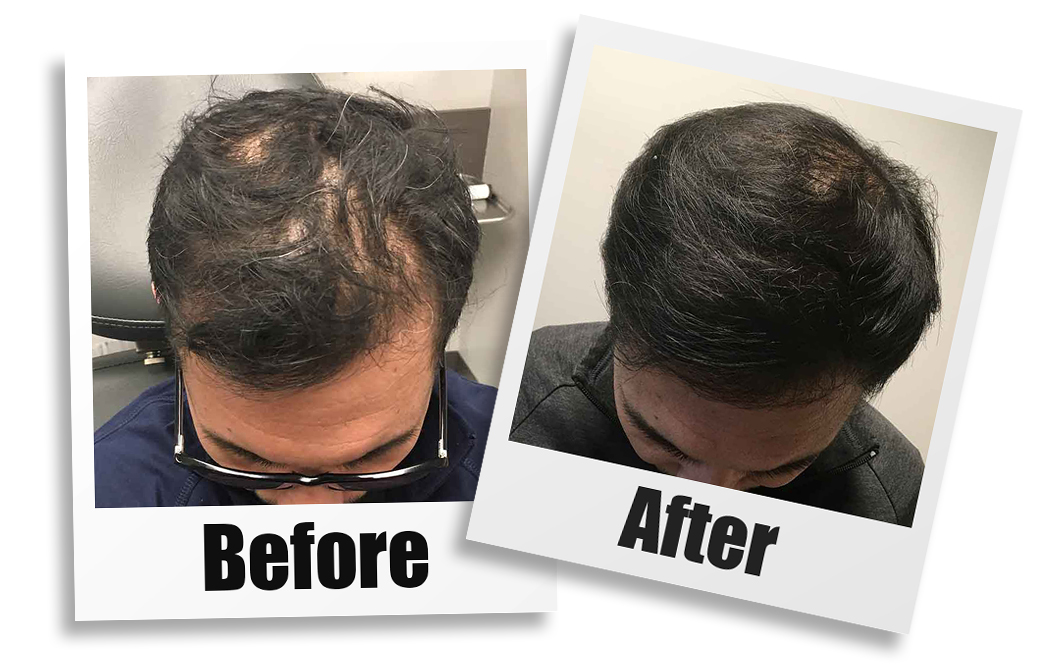 PRP with ACell Hair Restoration in Seattle, Bellevue, and Kirkland