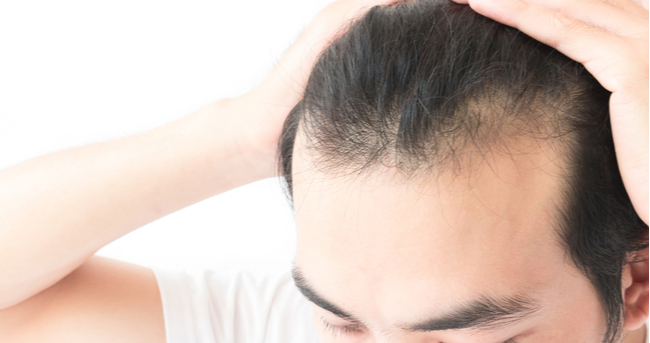 A Photo For A Blog Post About How To Fight Thinning Hair With PRP Hair Restoration