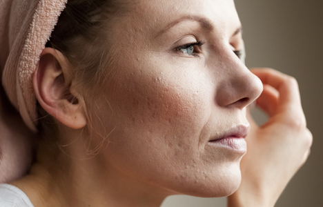 Photo For Blog Post About The Best Acne Scar Treatment Seattle