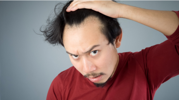 Hair Restoration Questions: Is PRP Hair Restoration Permanent?