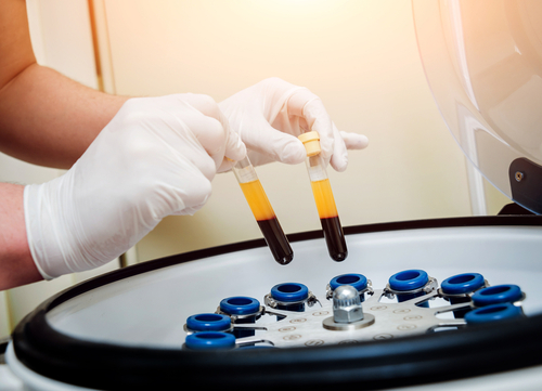 A Photo For A Blog Post About The Science Behind Platelet Rich Plasma
