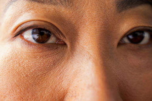 What Are The Side Effects Of PRP Under Eye Injections?