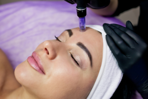 A Photo For A Blog Post About Benefits Of Combining PRP Microneedling And Chemical Peels