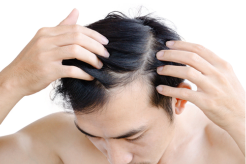 A Photo For A Blog Post About Does PRP Work For Frontal Hair Loss