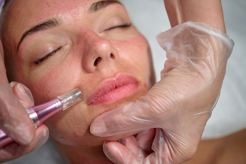 A Photo For A Blog Post About The Risk Of Doing Microneedling With PRP Too Often