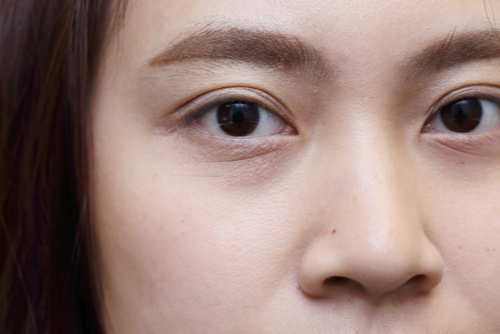 A Photo For A Blog Post About How Long Does It Take For PRP To Work Under The Eyes?