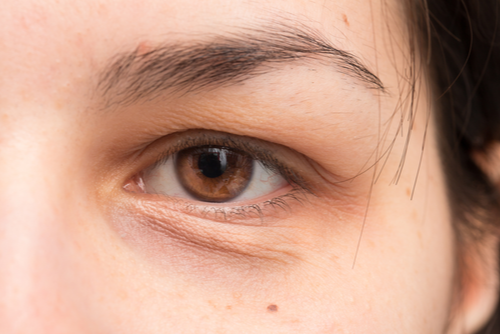 How Many PRP Sessions Are Needed For Dark Circles?
