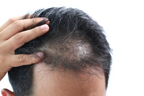 Is PRP Better Than Minoxidil?