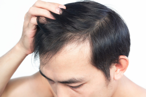 A Photo For A Blog Post About Is PRP Recommended After Hair Transplant