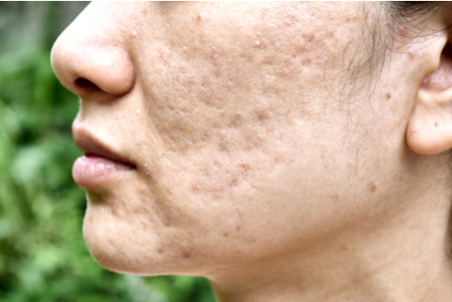 A Photo For A Blog Post About Are PRP Injections or PRP Microneedling Better For Acne Scars