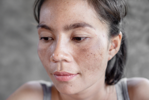 A Photo For A Blog Post About Does PRP Get Rid Of Melasma