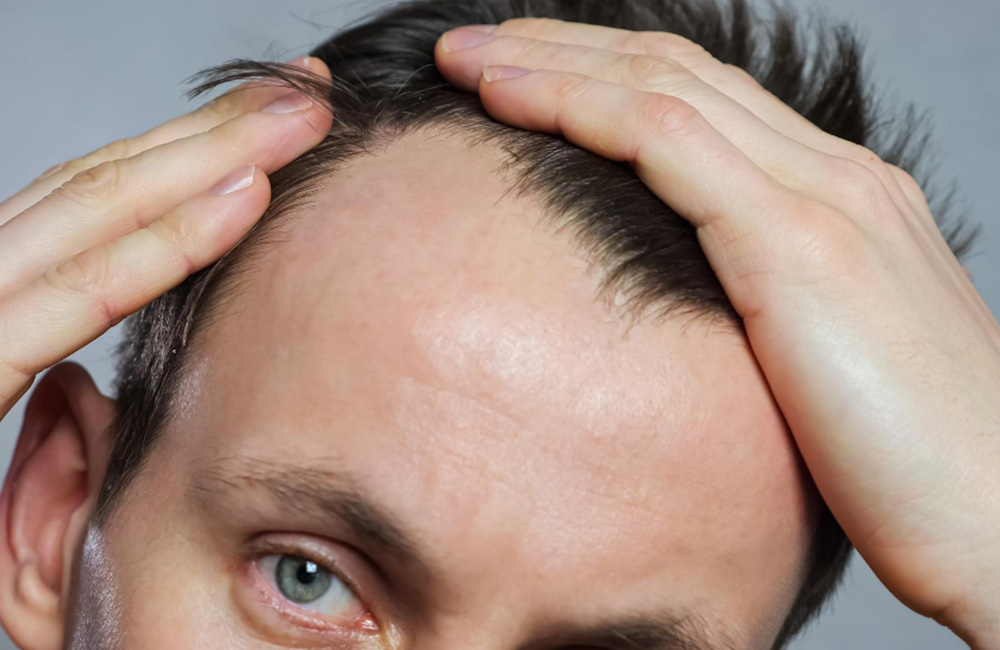 Why You Should Do PRP After a Hair Transplant: What the Benefits Are