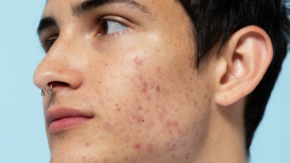 Acne Scars-co2-laser (1)
