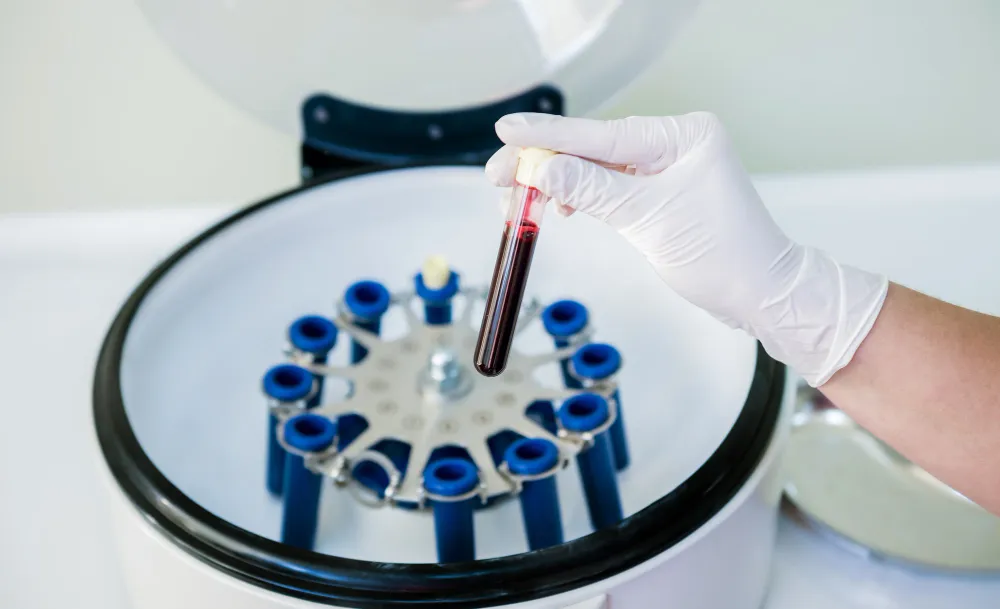 prp-treatment (2)