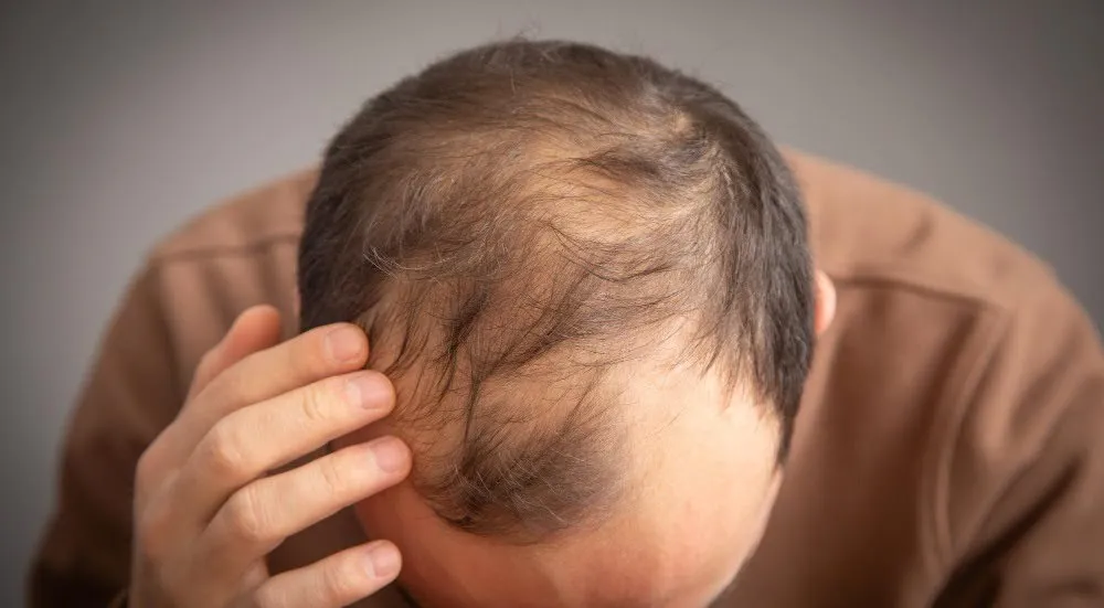 Hair-Loss-Treatment-03 Signs It May Be Time to Seek Hair Loss Treatment