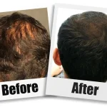 Non-Surgical-Hair-Restoration-Seattle-ab