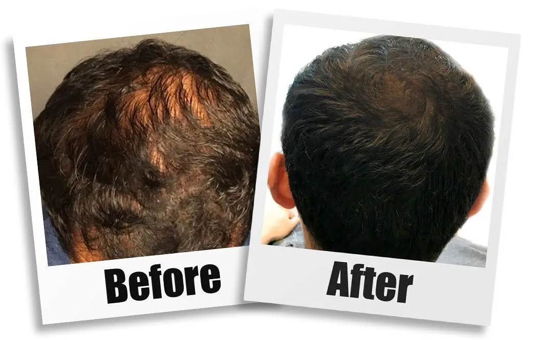 Non-Surgical-Hair-Restoration-Seattle-ab
