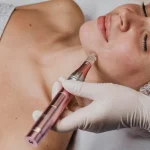 Does Microneedling With PRP Improve Skin Texture?