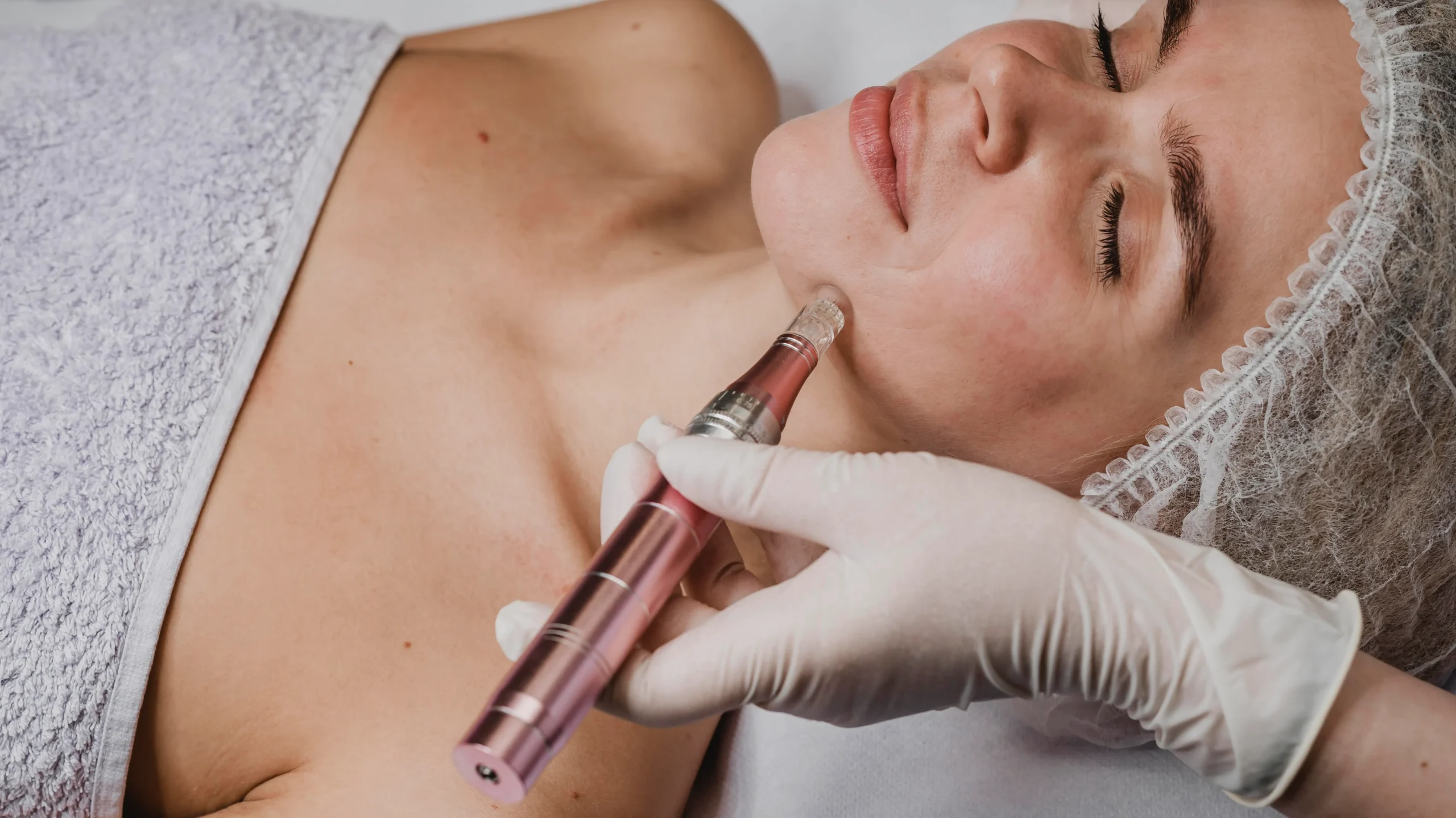 Does Microneedling With PRP Improve Skin Texture