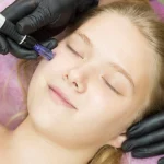 Microneedling with PRP for Radiant Skin in Seattle