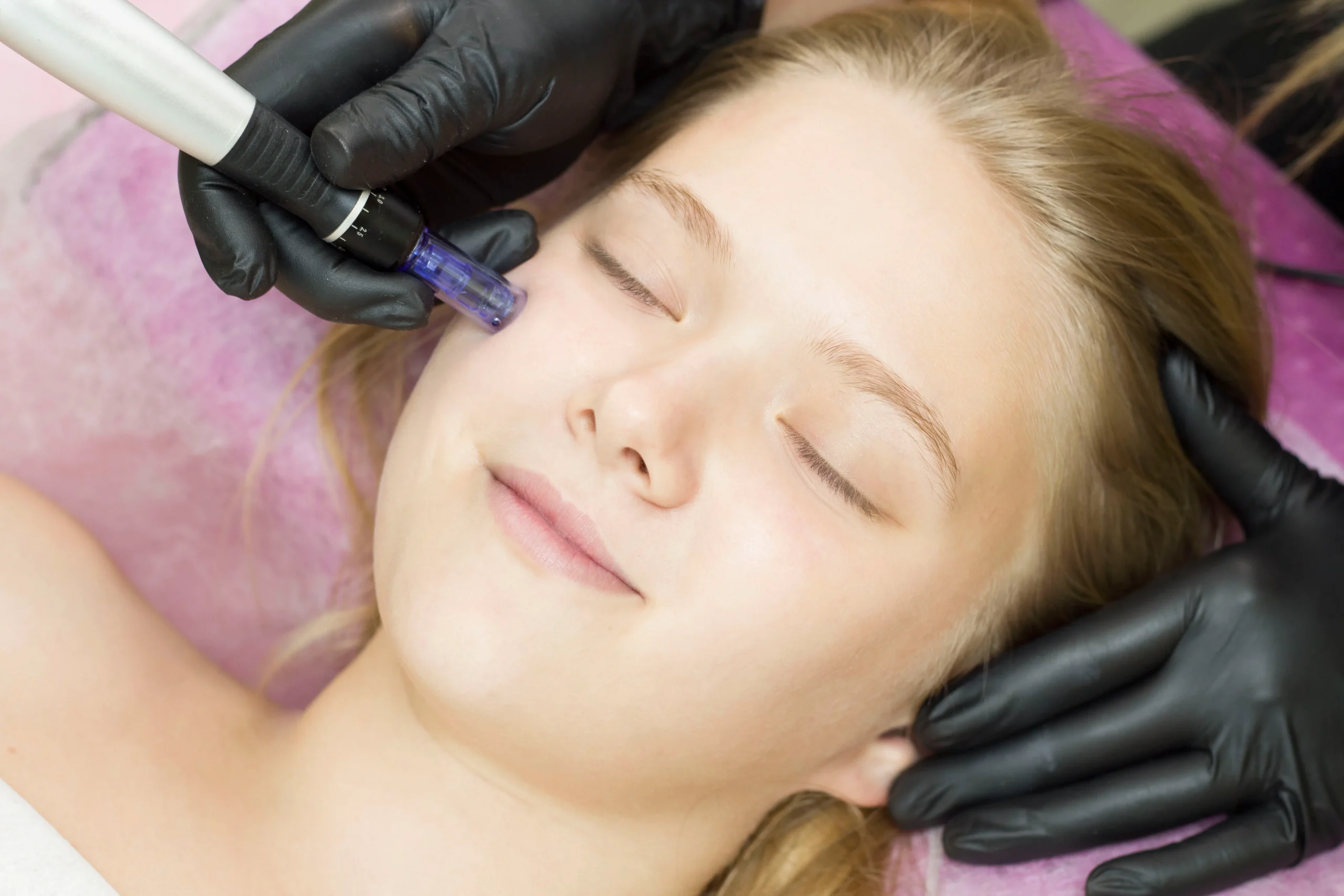 Microneedling with PRP for Radiant Skin in Seattle
