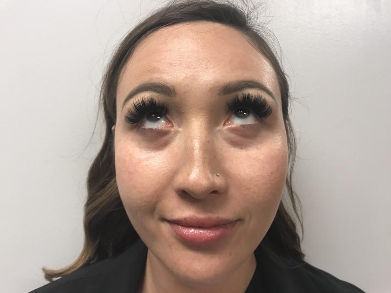 A Before Photo of PRP For Tear Troughs Injections By Injector Lynda in Seattle, Bellevue, and Kirkland