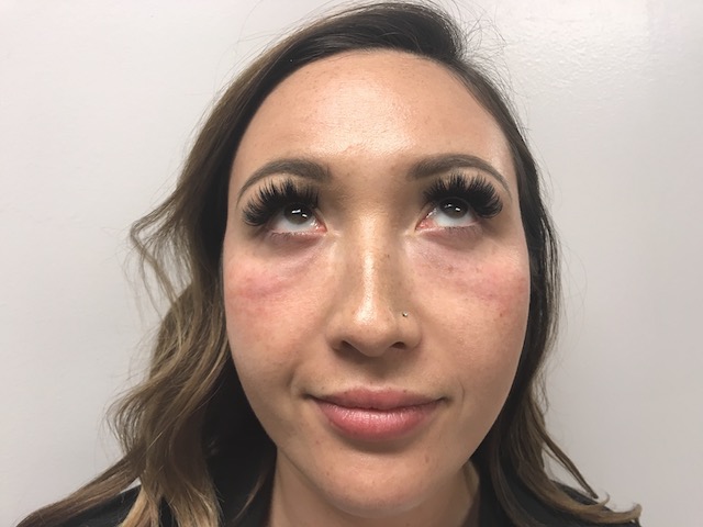 PRP For Tear Troughs Case #5