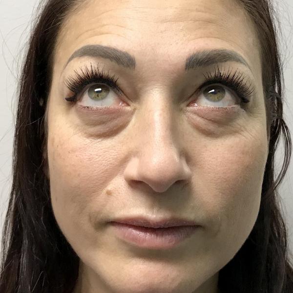 A Before photo of PRP For Tear Troughs by Injector Lynda in Seattle, Bellevue, and Kirkland