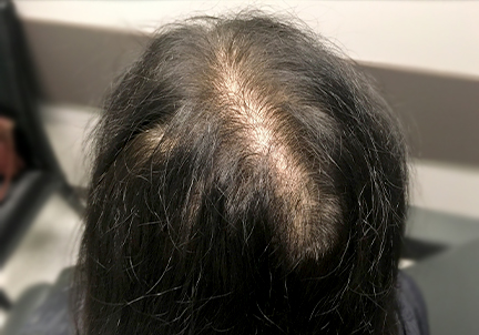 A Before Photo of PRP With ACell Hair Restoration In Seattle, Bellevue, and Kirkland