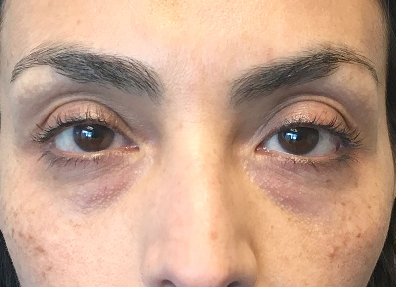 A Before photo of PRP For Tear Trough Injections by Dr. Javad Sajan in Seattle, Bellevue, and Kirkland