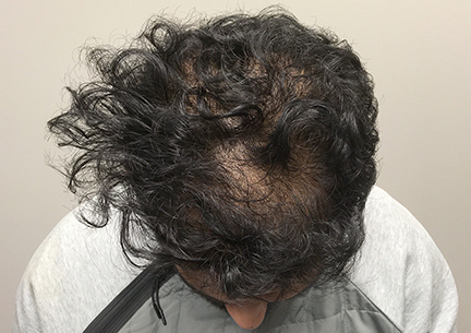 A Before Photo of PRP With Placenta Hair Restoration in Seattle