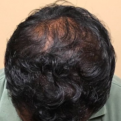 PRP With ACell Case #8