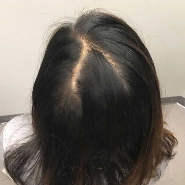 PRP With ACell Case #7