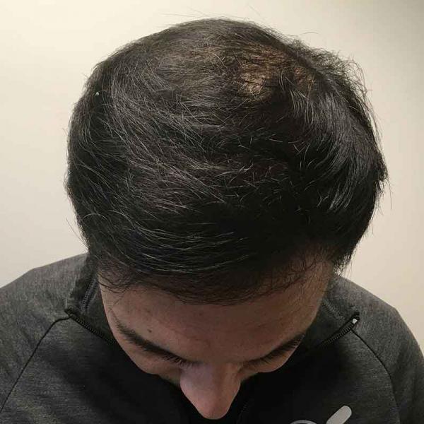 PRP With ACell Case #6