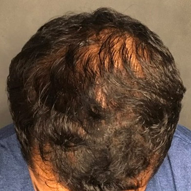 A Before photo of PRP With ACell Hair Restoration by Dr. Javad Sajan in Seattle, Bellevue, and Kirkland