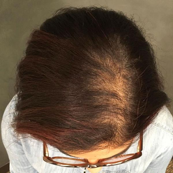 A Before photo of PRP With ACell Hair Restoration by Dr. Javad Sajan in Seattle, Bellevue, and Kirkland