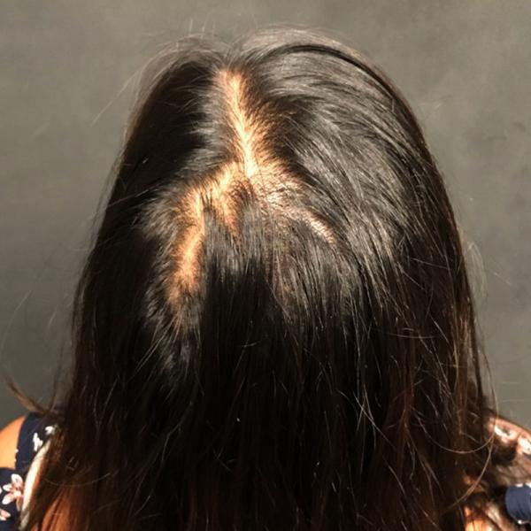 A Before photo of PRP With ACell Hair Restoration by Dr. Javad Sajan in Seattle, Bellevue, and Kirkland