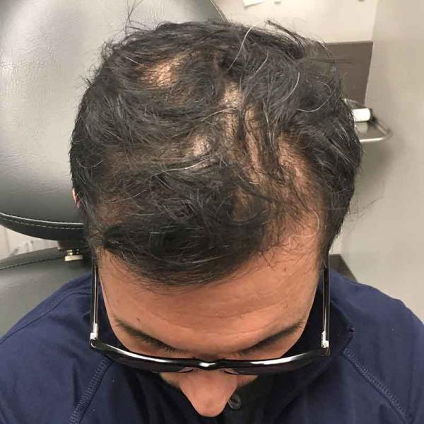 A Before photo of PRP With ACell Hair Restoration by Dr. Javad Sajan in Seattle, Bellevue, and Kirkland