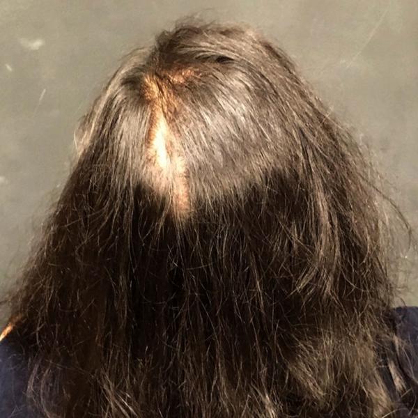 A Before photo of PRP With ACell Hair Restoration by Dr. Javad Sajan in Seattle, Bellevue, and Kirkland