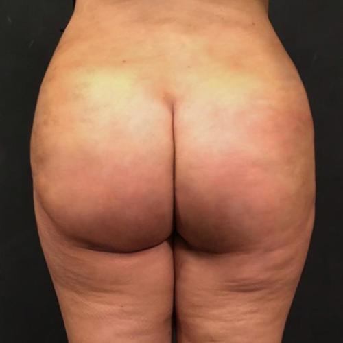 Non-Surgical Brazilian Butt Lift Case #2