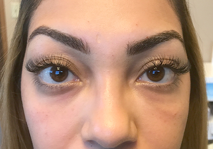 PRP For Tear Troughs Case #4